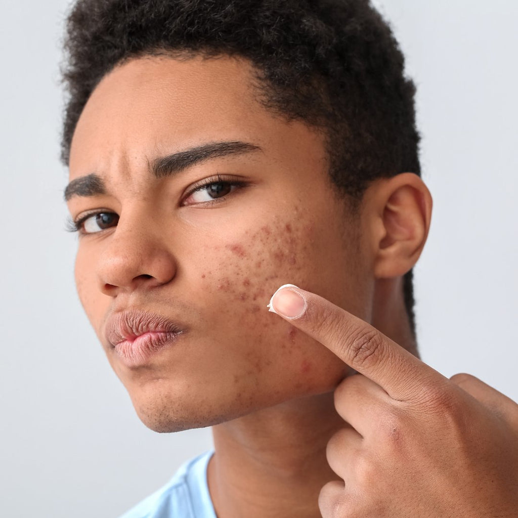 side profile african american boy with acne applying creme to left cheek
