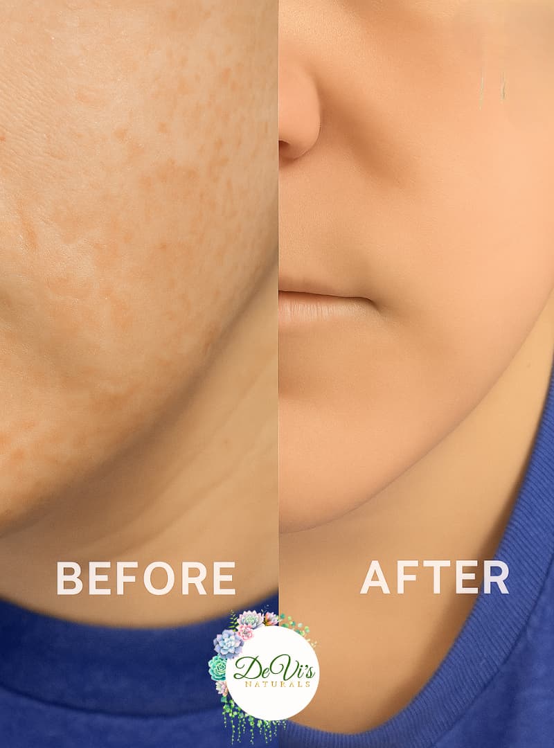 Before and after comparison of skin treatment on a person wearing a blue shirt, with DeVi's logo.